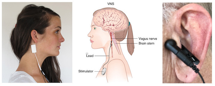 Using TENS Machine for Vagus Nerve Stimulation